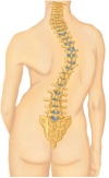 Picture of spine with scoliosis